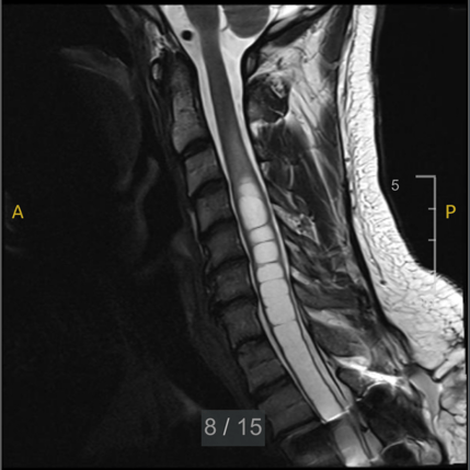 Spinal cord imaging illustrating syrinx and gradual neurological symptom progression