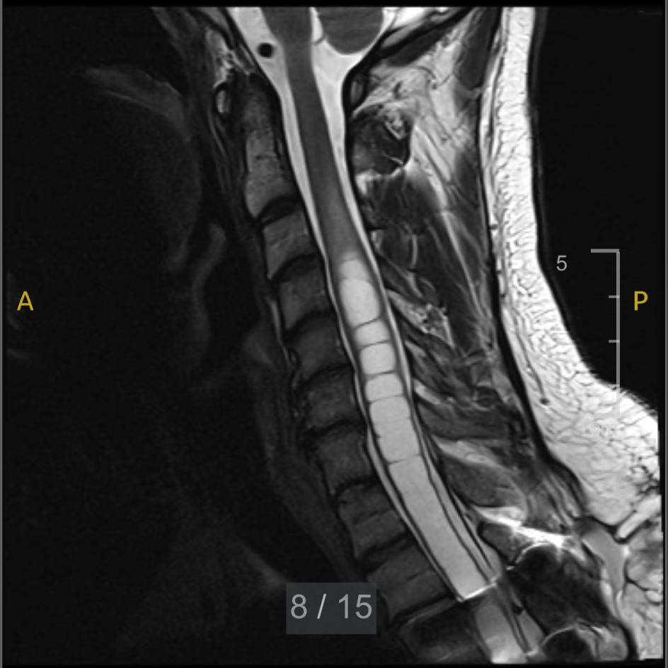 Syrinx of the Spinal Cord: Kortlund Natterstad Insights | QuickChange