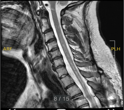 MRI scan showing fluid-filled syrinx within the spinal cord used for diagnosis and monitoring