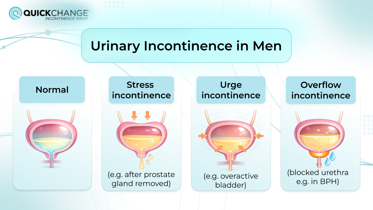 urinary incontinence in men with four conditions: normal bladder, stress incontinence after prostate removal, urge incontinence from overactive bladder, and overflow incontinence due to blocked urethra such as BPH.